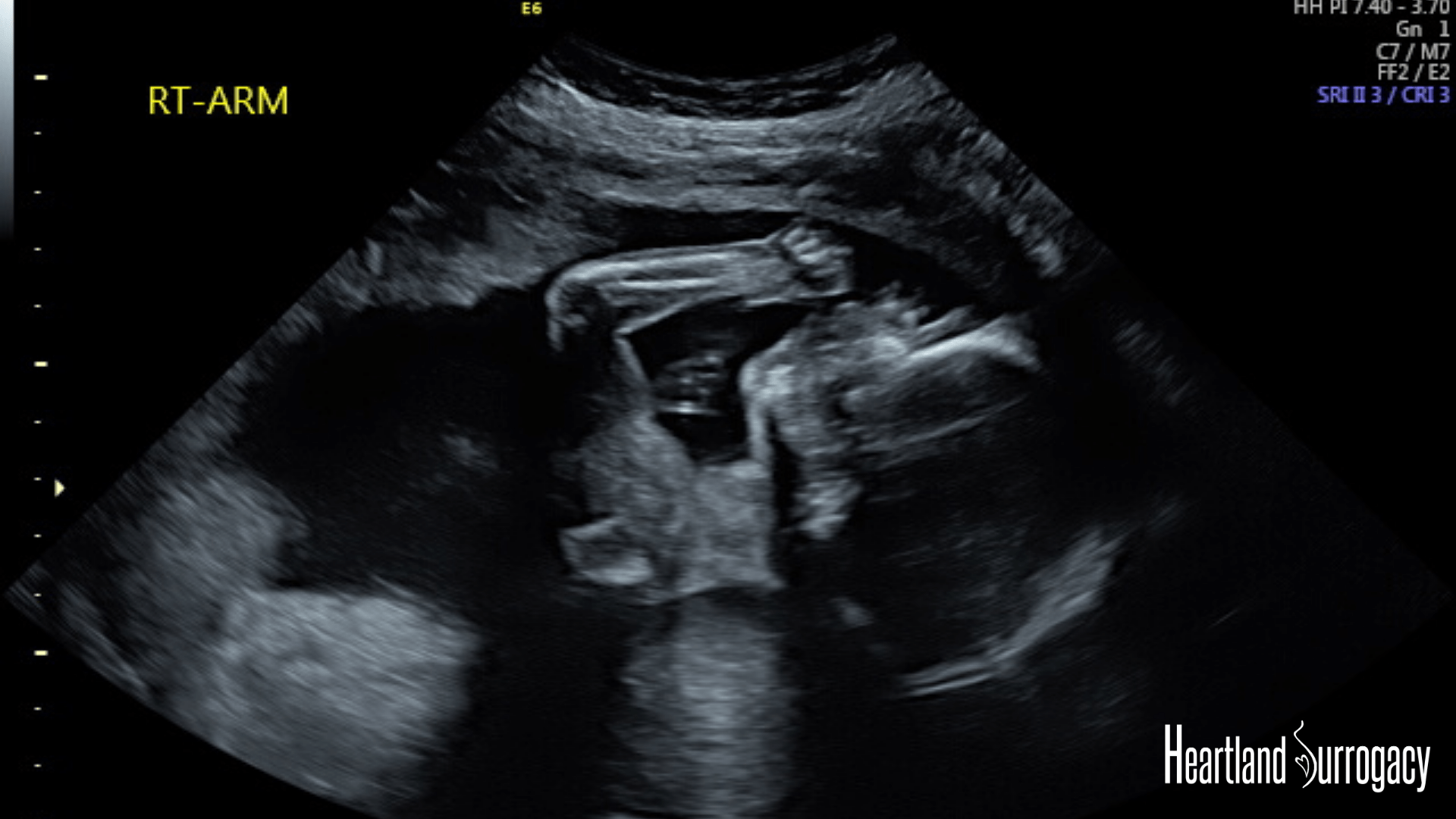20 weeks ultrasound